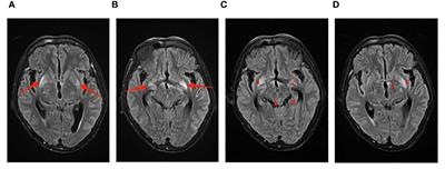 Case report: Experience and insights on the treatment of two cases of cryptococcal meningitis during the later stages of the COVID-19 pandemic